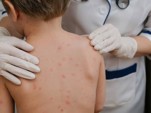 Chickenpox is a viral infection that mostly affects children, although you can get it at any age