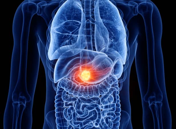 <p>Here are signs of pancreatic cancer you can look out for </p>