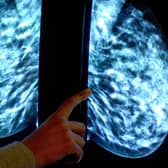 More than 35,000 women miss vital breast cancer screenings in Lancashire