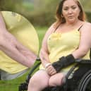 Emma Doherty has been left permanently disfigured and in a wheelchair after contracting necrotising fasciitis , also known as the 'flesh-eating disease'.