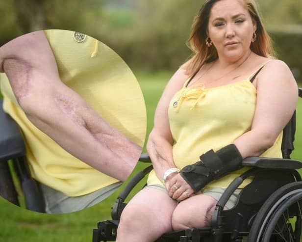 Emma Doherty has been left permanently disfigured and in a wheelchair after contracting necrotising fasciitis , also known as the 'flesh-eating disease'.