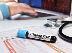 Monkeypox has now been declared a global emergency