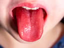 Tongue of a child with scarlet fever - strawberry tongue.