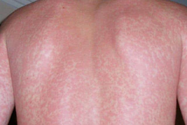 The first signs of scarlet fever can be flu-like symptoms, including a high temperature, a sore throat and swollen neck glands. A rash appears 12 to 48 hours later which looks like small, raised bumps and starts on the chest and tummy before spreading