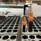 Currently, all blood tests and other pathology samples are processed at local hospital sites across Lancashire