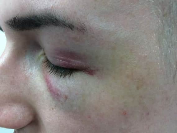 A 22-year-old man suffered a black eye and bruising and swelling to his face after an unprovoked attack in Burnley town centre.