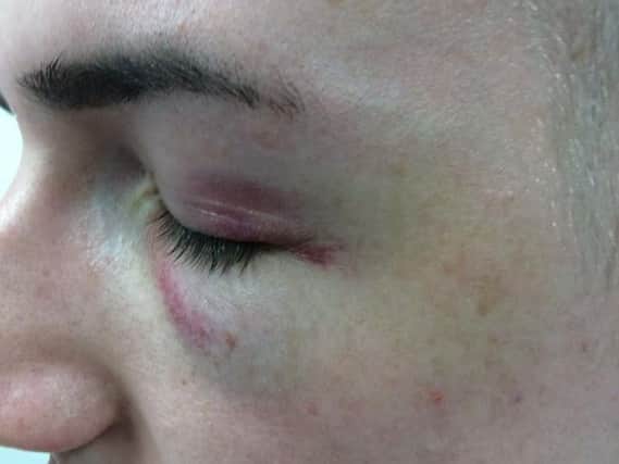The 22-year-old victim of an 'isolated and unprovoked' homophobic attack in Burnley town centre was left with a black eye and bruising and swelling to his face.