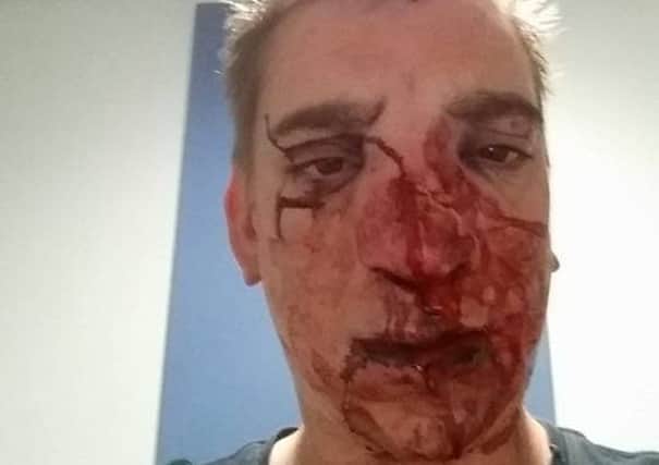 Anthony Wade was attacked on a night out in Poulton