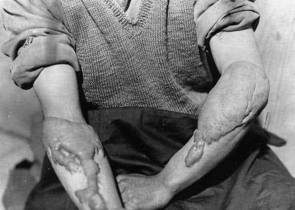 A victim of the American atomic bombing of Hiroshima shows the burns on his arms (Photo: Keystone/Getty Images)